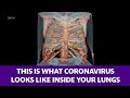 This 3-D model shows what coronavirus looks like inside your lungs