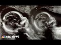 Alabama woman born with double uterus expecting a baby in both